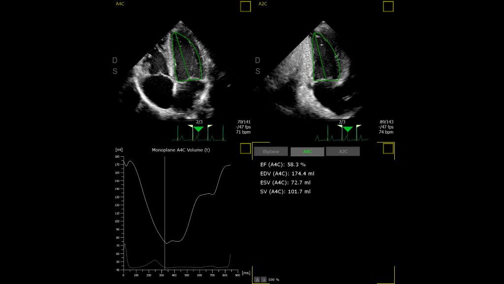 Automated Ejection Fraction using AutoStrain functionality.