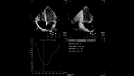 Automated Ejection Fraction using AutoStrain functionality.