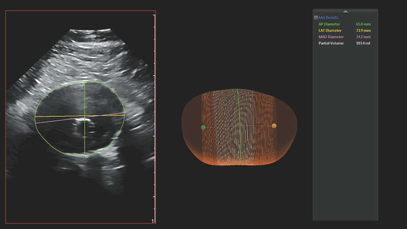 Clinical image of a Philips AAA model scan with anterior-to-posterior diameter and partial volume measurements