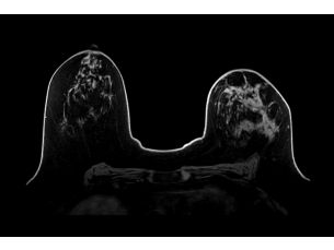 SmartSpeed Precise - Breast MR Clinical applications