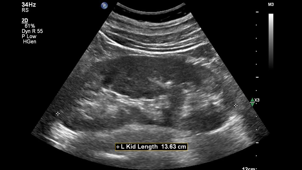 Clinical image using C9-2 transducer and Affiniti showing abdominal left kidney length with Auto Measure Abdomen  