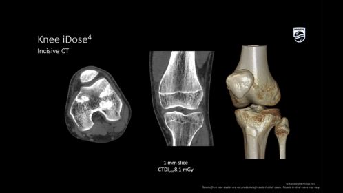 Incisive CT CT Scanner | Philips