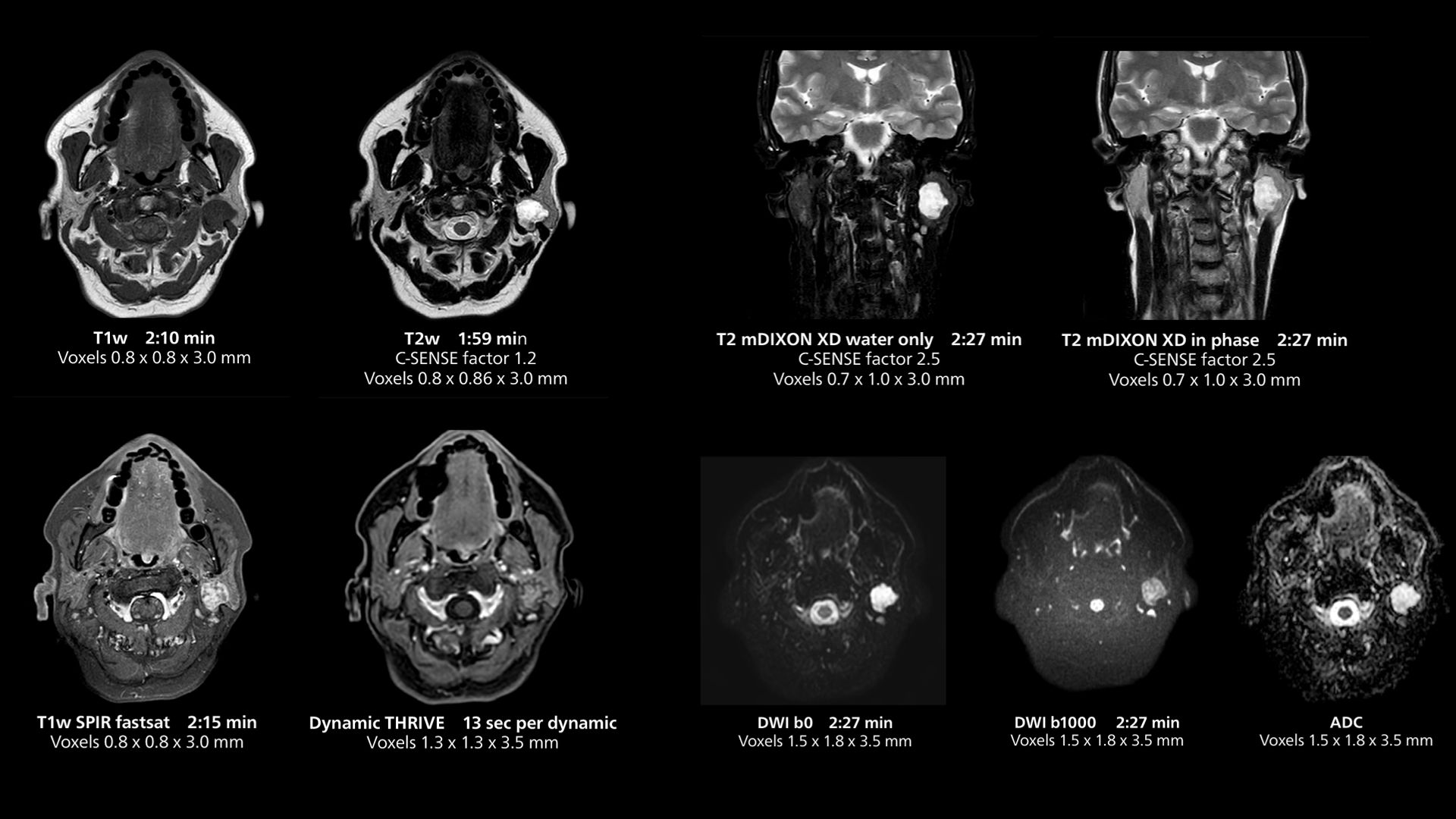 Salivary gland imaging using MR 5300