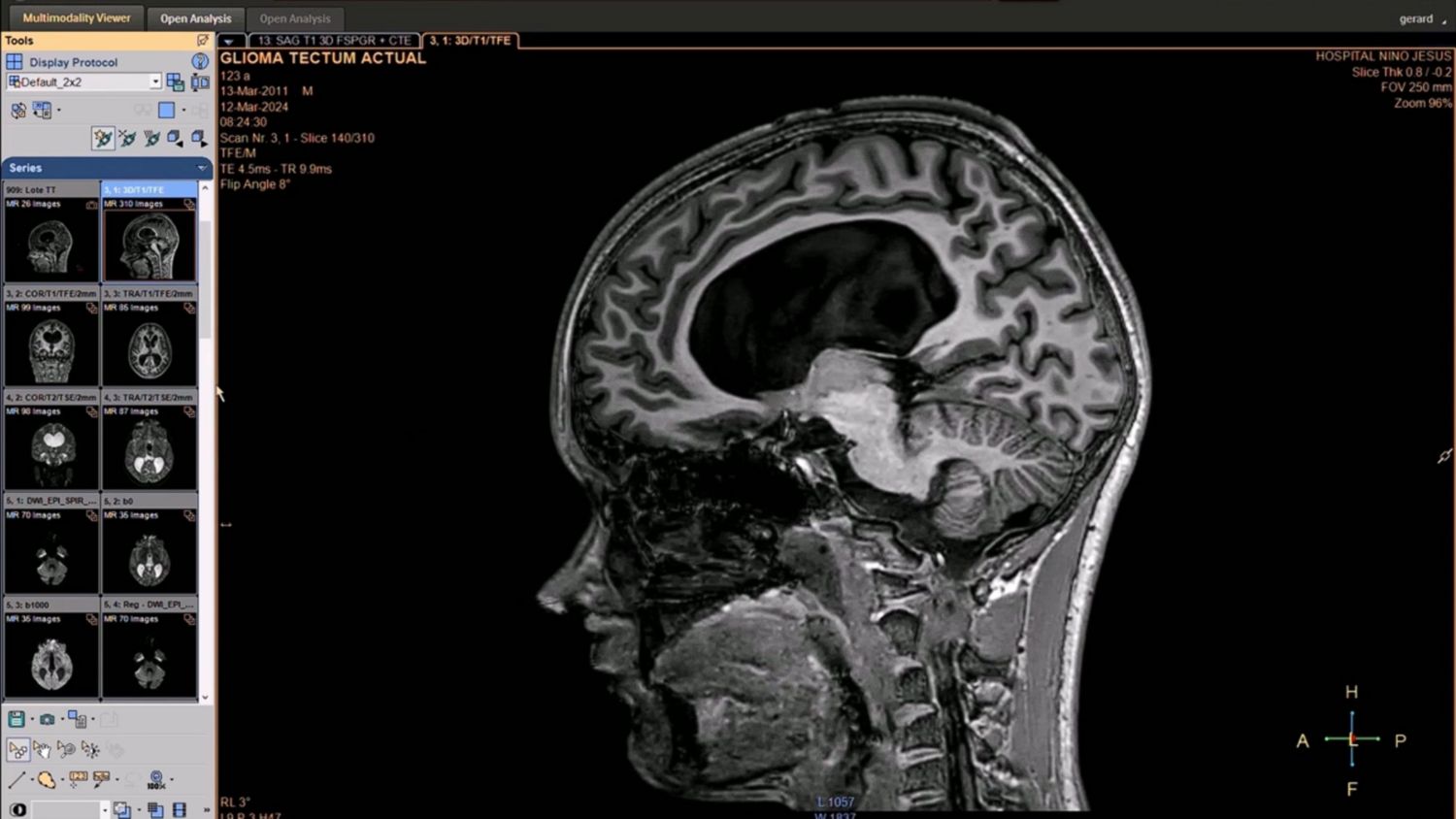 MR case review: Follow-up study of a 12-year-old boy with a low grade glioma at Hospital Infantil Universitario Niño Jesús