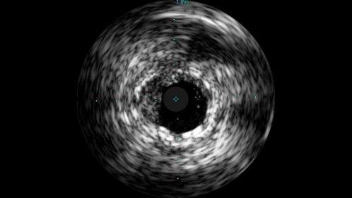 Grayscale imaging enhances standard angiography procedures