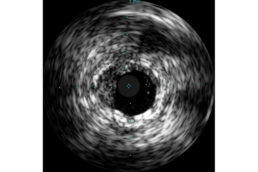 Grayscale imaging enhances standard angiography procedures