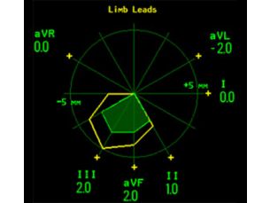 ST Map Graphical display of ST segment data