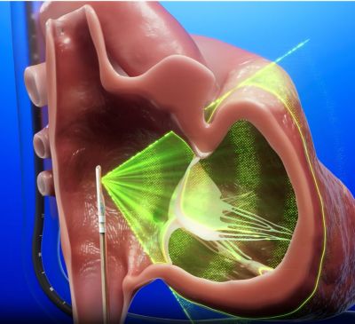 VeriSight Pro 3D ICE Tricuspid Procedure Animation 