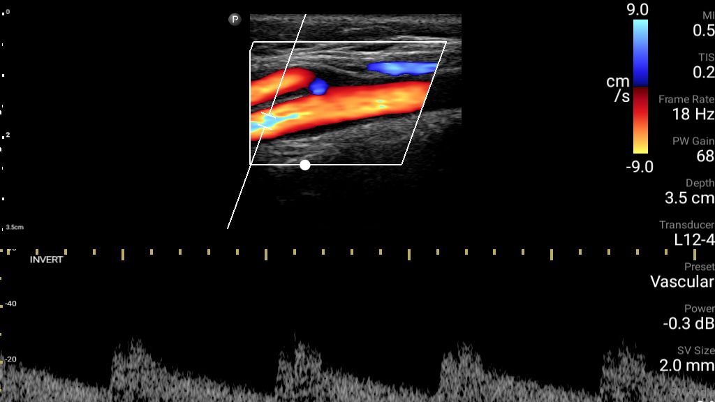Internal carotid artery with color and PW Doppler using L12-4 transducer.