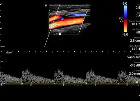 Internal carotid artery with color and PW Doppler using L12-4 transducer.