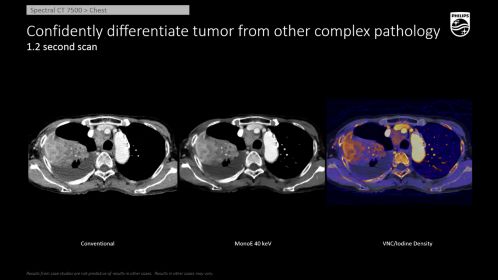 CT Spectral 7500 Chest Complex Lung Tumor and Addl Pathology