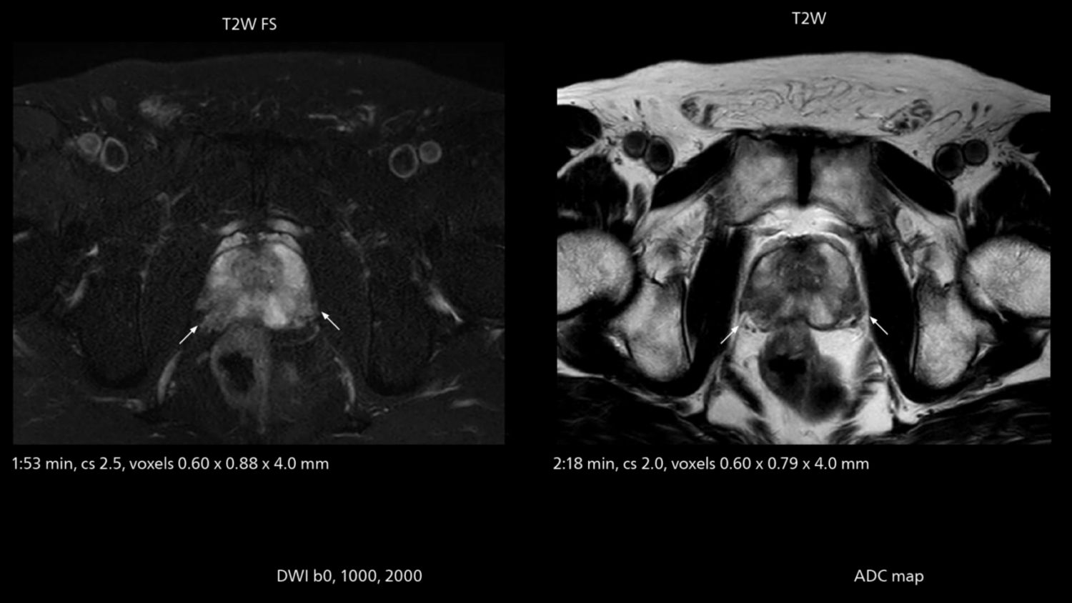 Prostate MRI showing cancer with PI-RADS score 4