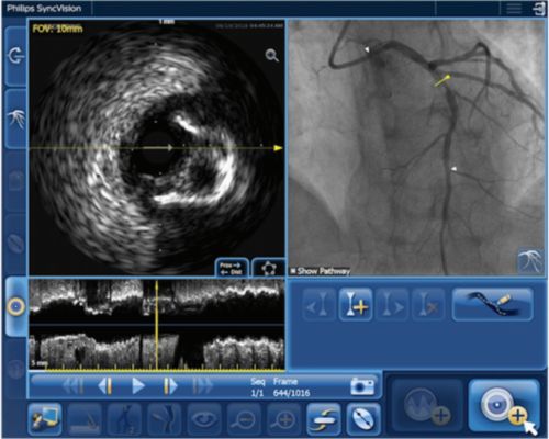 IVUS Co-registration