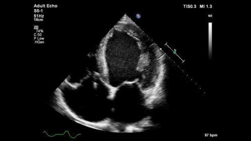 S5-1 Adult Echo