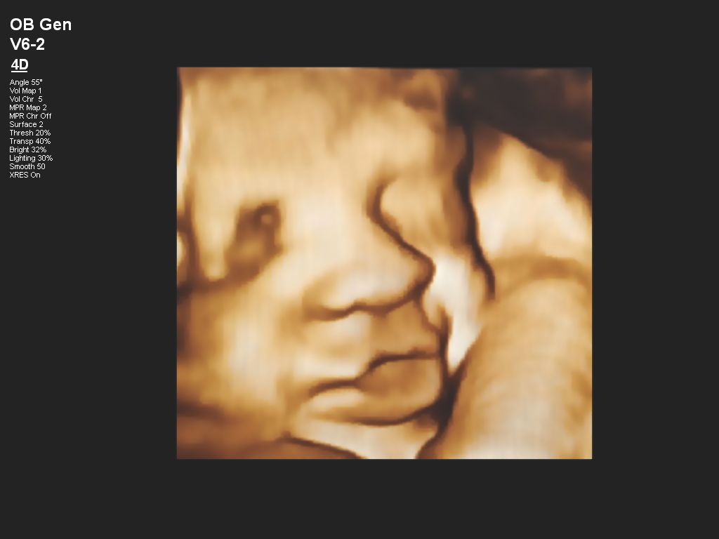 Affiniti 30 ultrasound clinical image obstetric fetal face