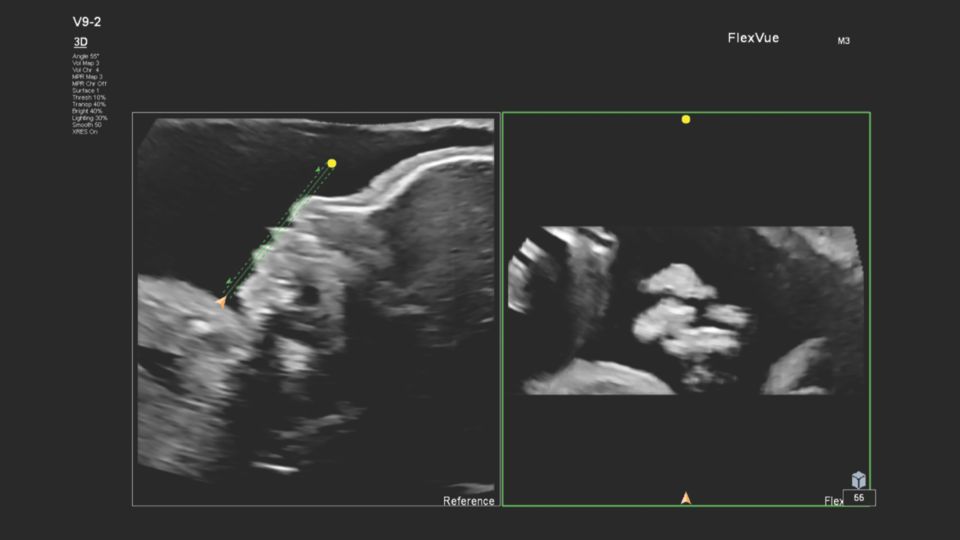 Figure 4 FlexVue line (green) demonstrating the corresponding coronal plane and unilateral cleft lip