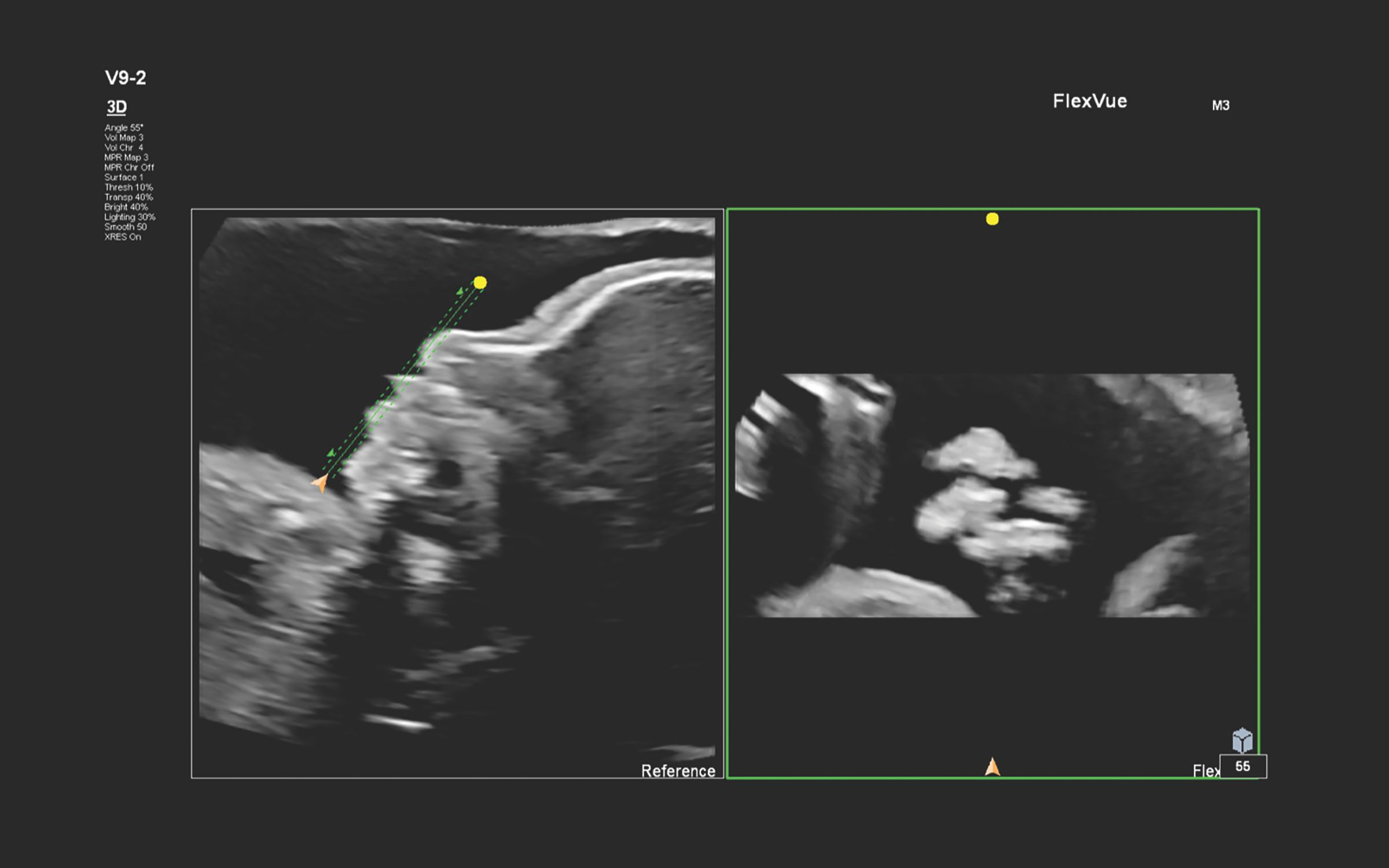Figure 4 FlexVue line (green) demonstrating the corresponding coronal plane and unilateral cleft lip