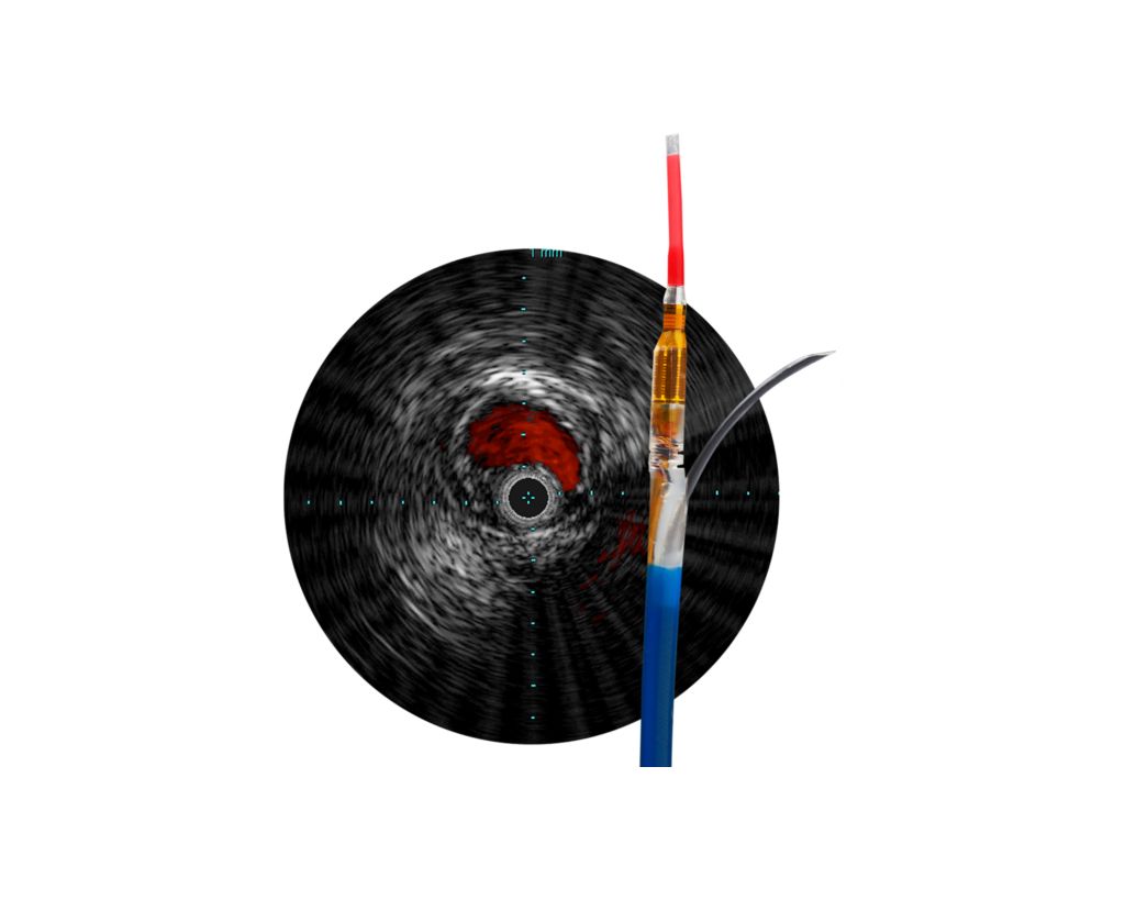 Pioneer Plus IVUS-guided re-entry catheter