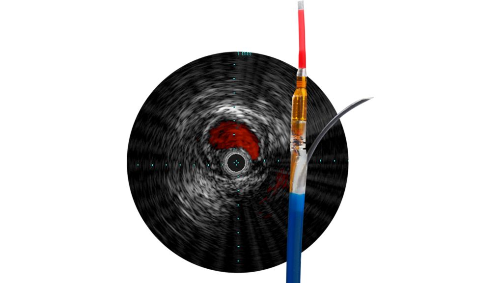 Pioneer Plus IVUS-guided re-entry catheter
