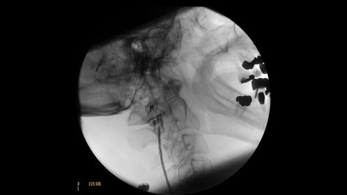 Clinical Image Philips BV Mobile C-arm Pulsera