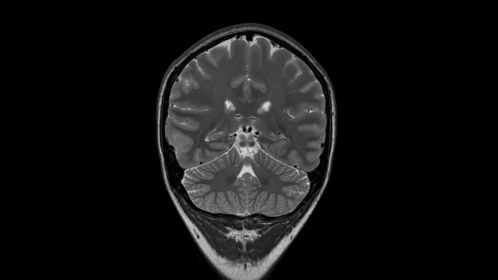 T2w TSE (hippocampus)