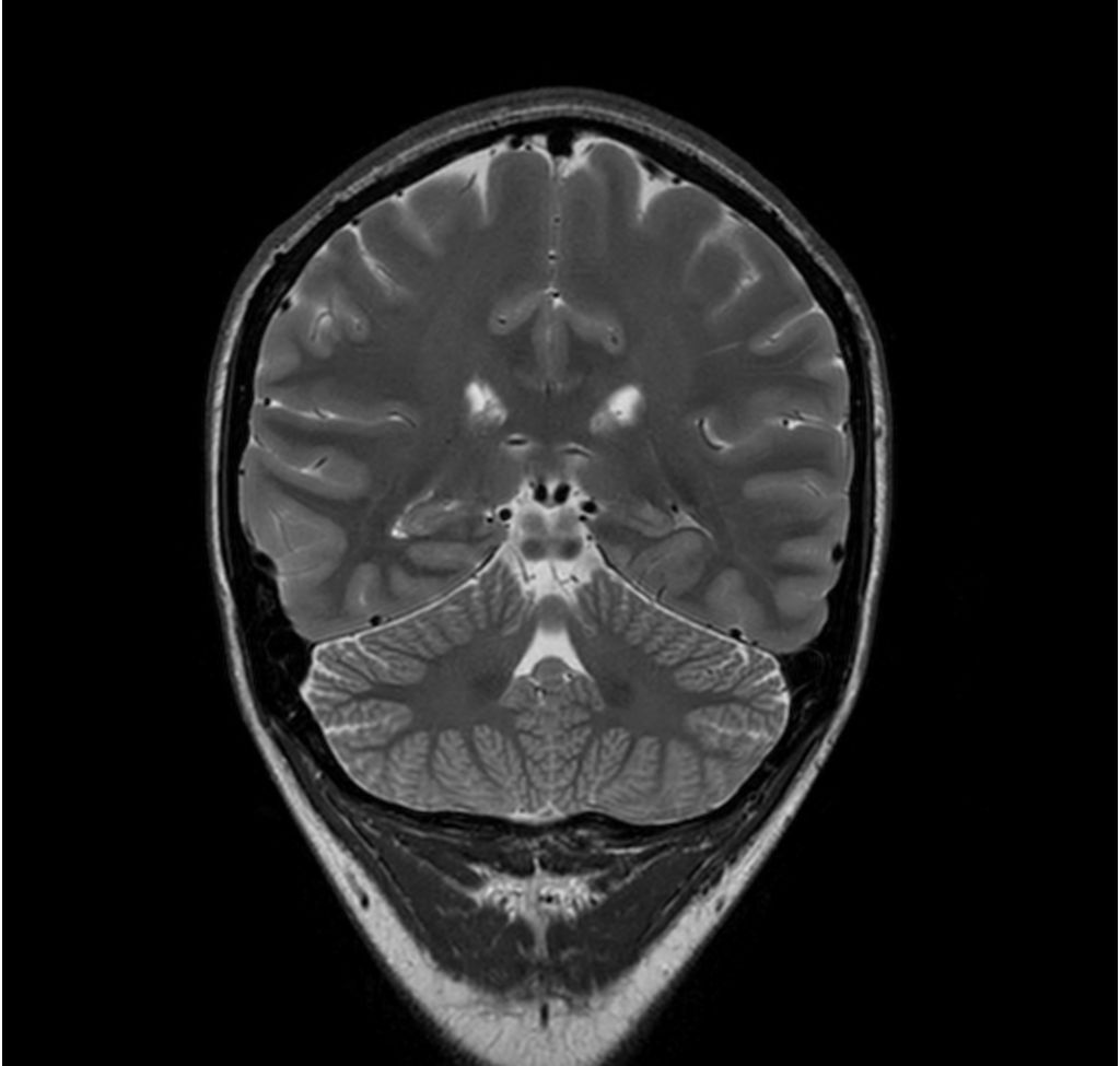 T2w TSE (hippocampus)