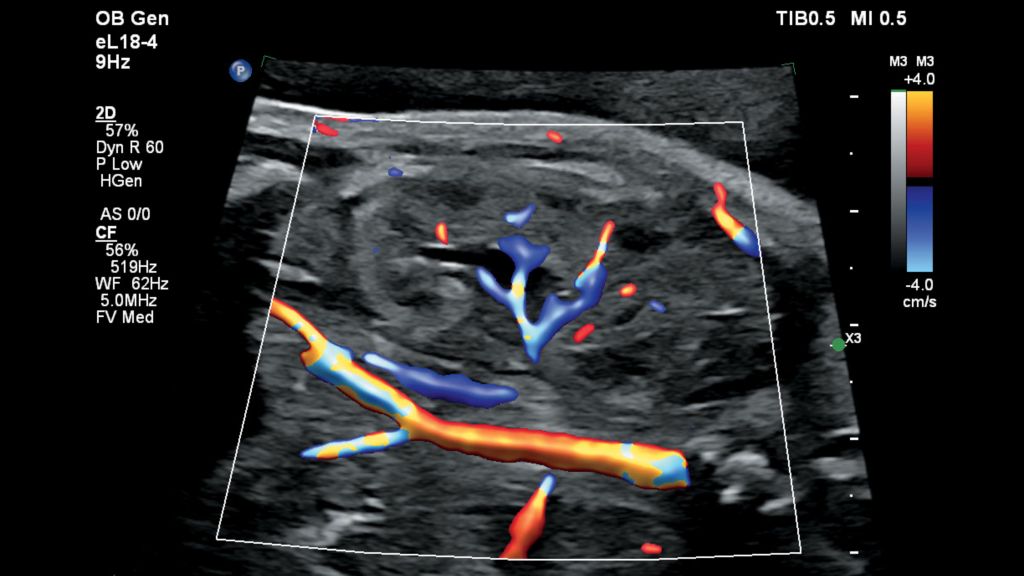 Flow Viewer applied to color flow with eL18-4 fetal kidney