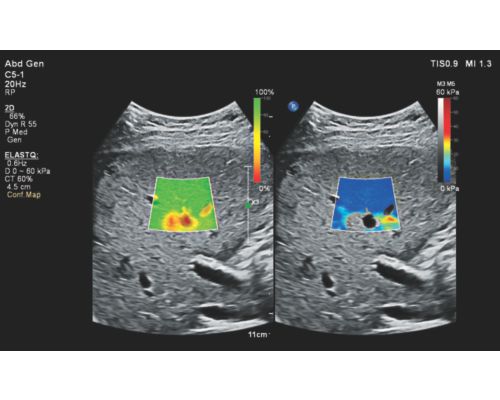 Philips ElastQ confidence map clinical image