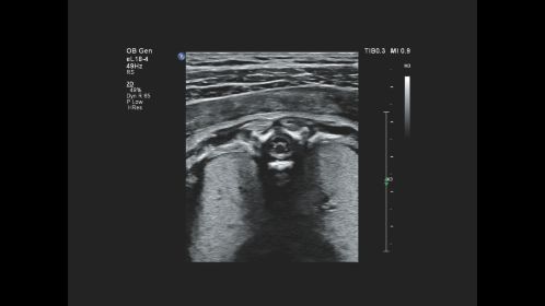 EPIQ Elite imaging with the eL18-4 reveals the fetal spinal cord