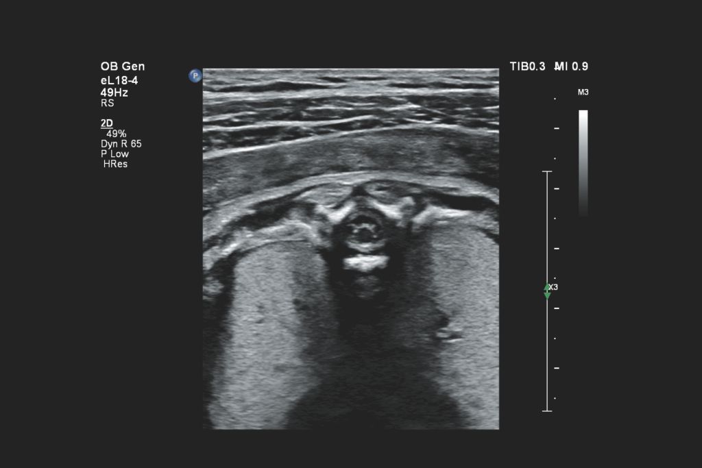 EPIQ Elite imaging with the eL18-4 reveals the fetal spinal cord