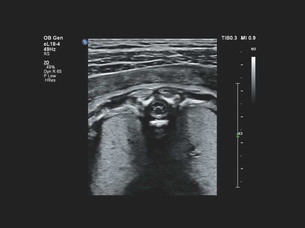 EPIQ Elite imaging with the eL18-4 reveals the fetal spinal cord