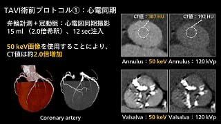 case 83
造影剤量低減
TAVI Planning CT