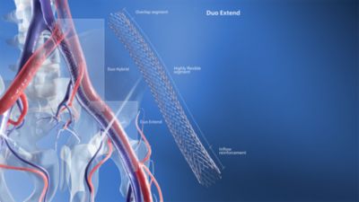 Image of Duo Extend stent with callouts of different features along the stent