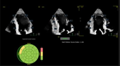 EPIQ CVx X5-1c Segmental Wall Motion Scoring