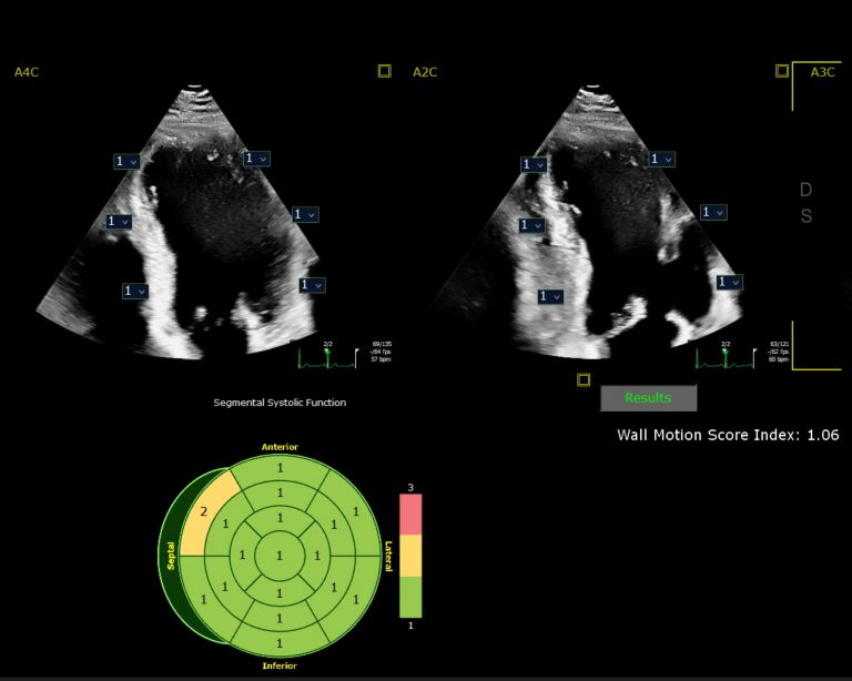 Auto SWM for AI-driven wall motion scores