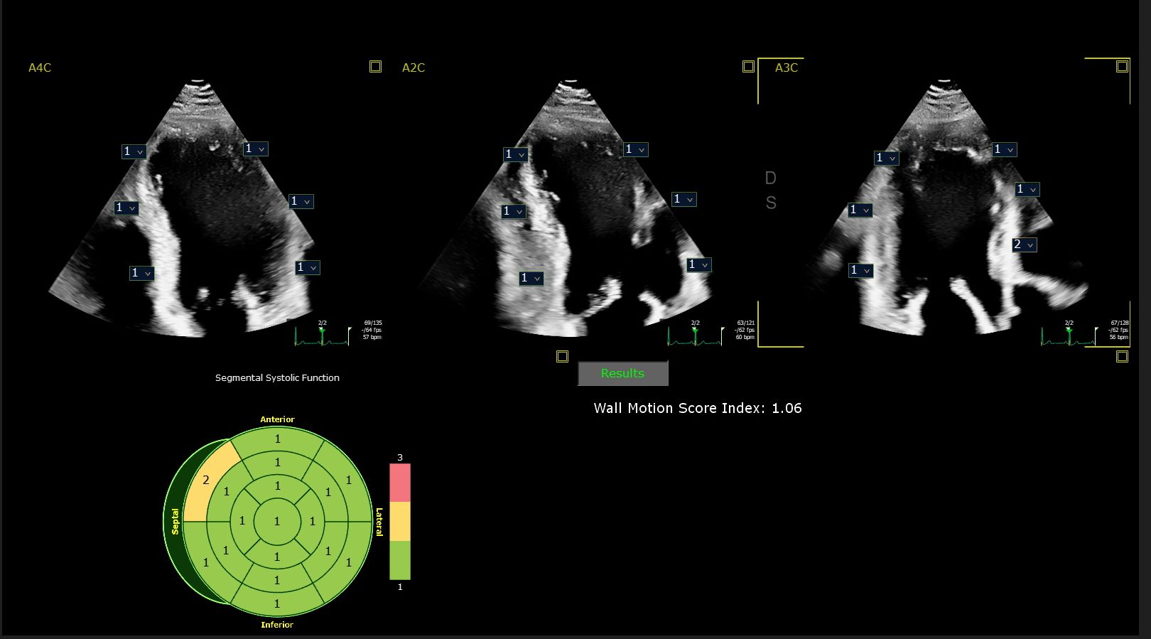 EPIQ CVx X5-1c segmentale wandbewegingsscore