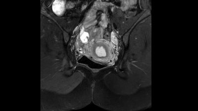 Philips - mDIXON XD TSE - Pelvis MR clinical application - Philips