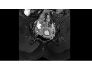 mDIXON XD TSE - Pelvis MR clinical application