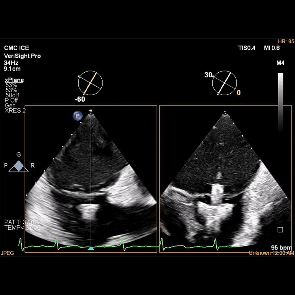 Enhance tricuspid valve visualization 
