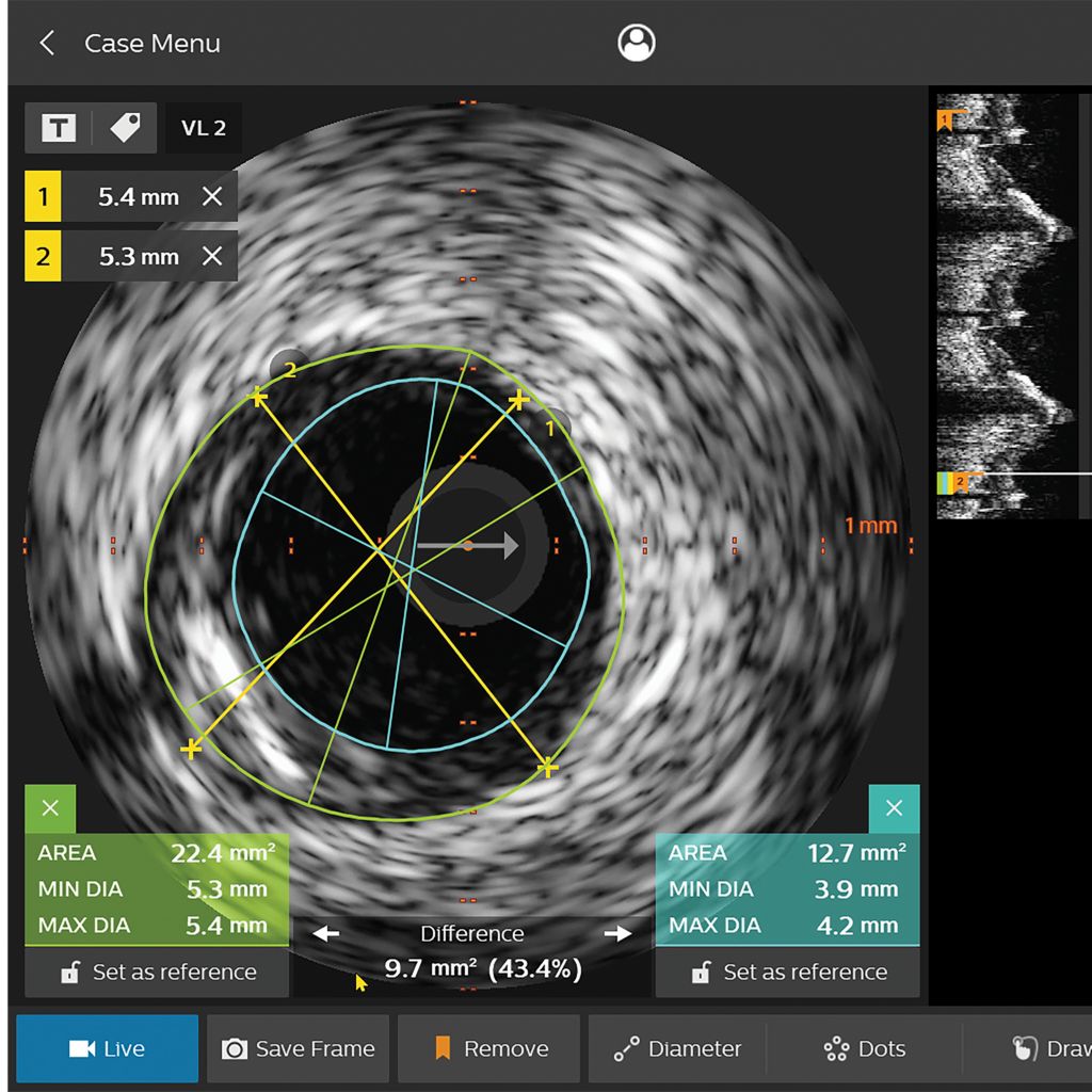 Assessment of lesion length