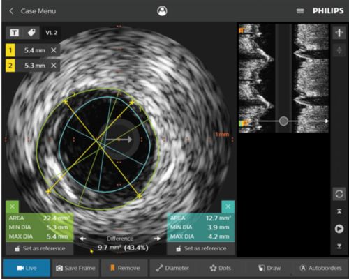 Assessment of lesion length