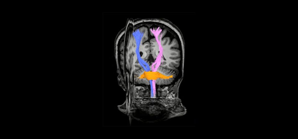 Diffusion Tensor Imaging (b800, 45 directions)