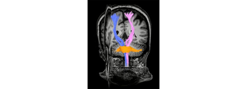 Diffusion Tensor Imaging (b800, 45 directions)