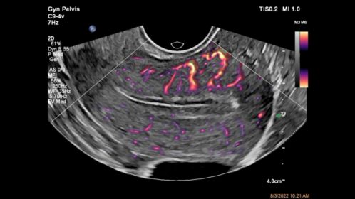 Gyn Pelvis ultrasound image shown with MFI using C9-4v transducer