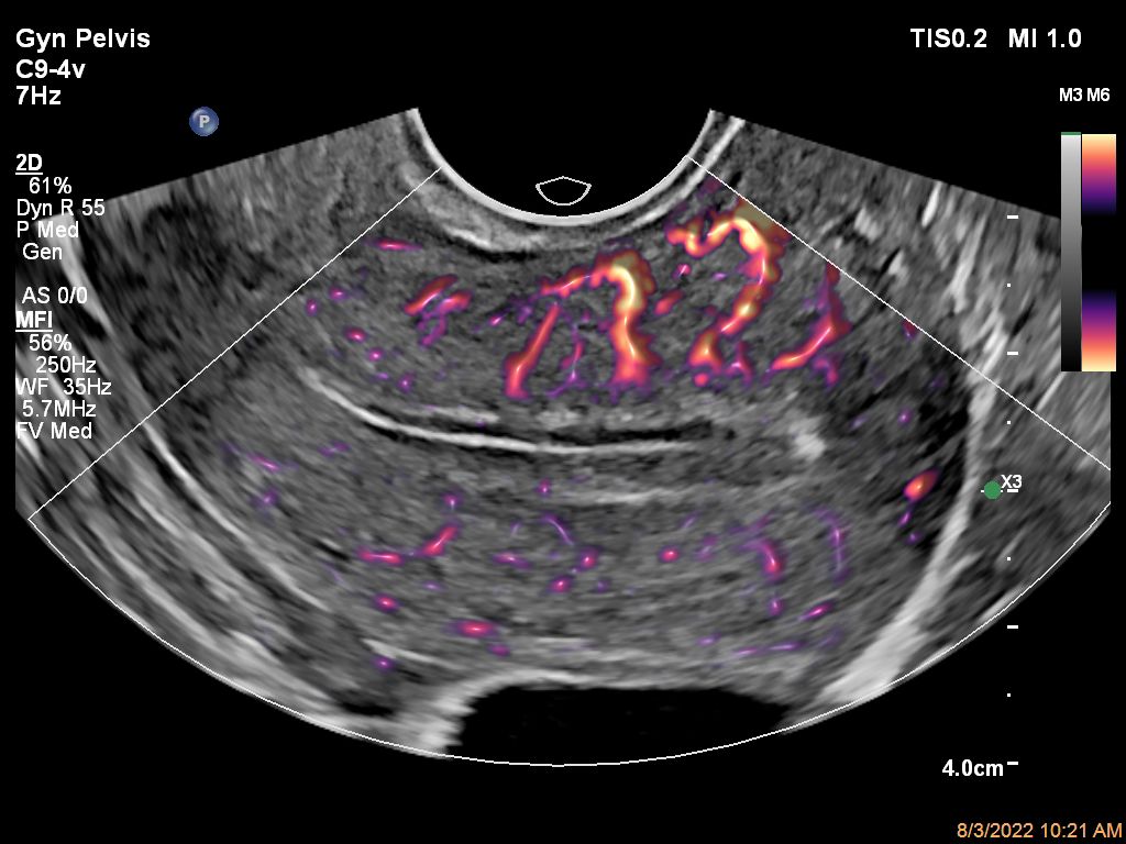 Gyn Pelvis ultrasound image shown with MFI using C9-4v transducer