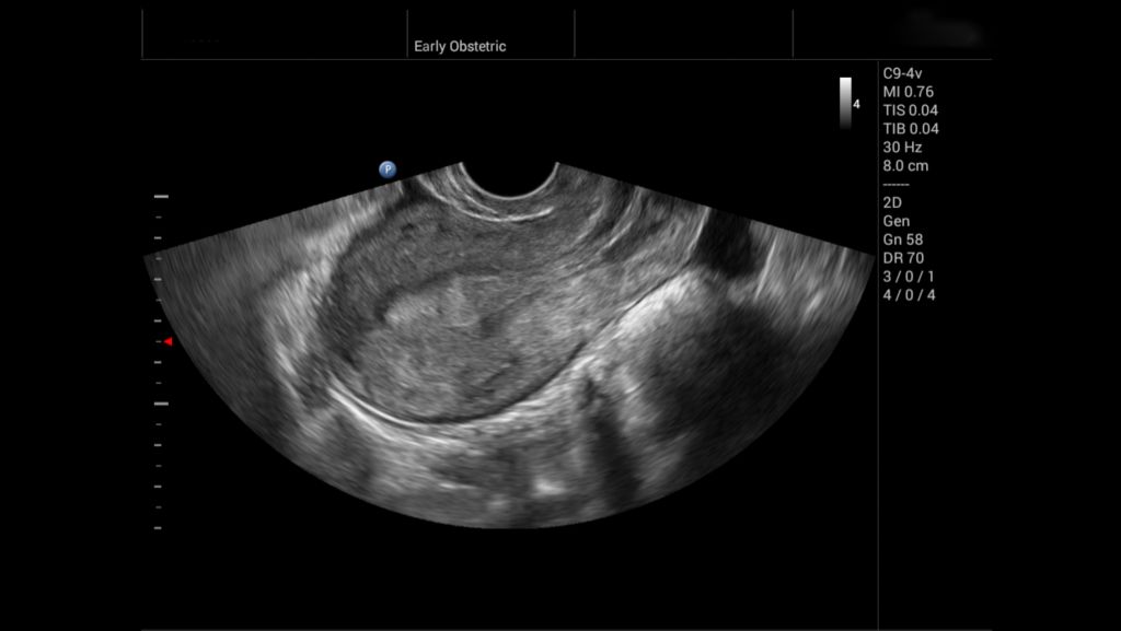 C9-4v Uterus & Endometrium