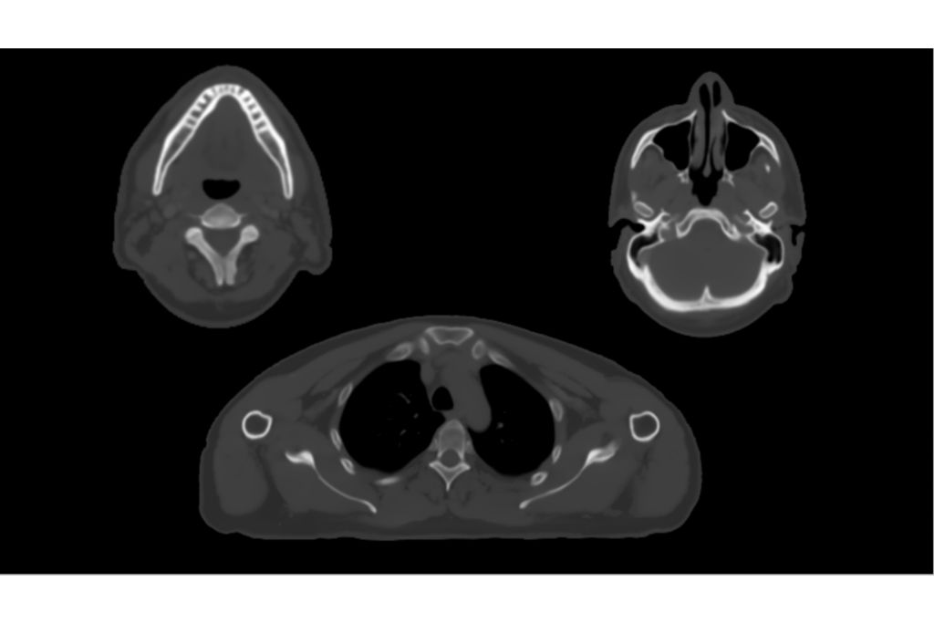 MRCAT Head and Neck with continuous Hounsfield Units