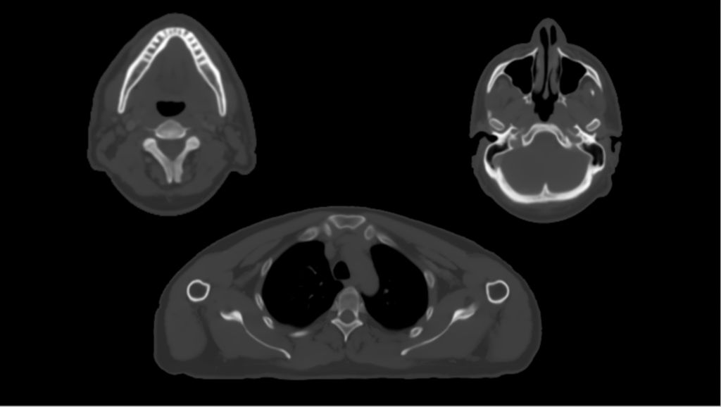 MRCAT Head and Neck with continuous Hounsfield Units