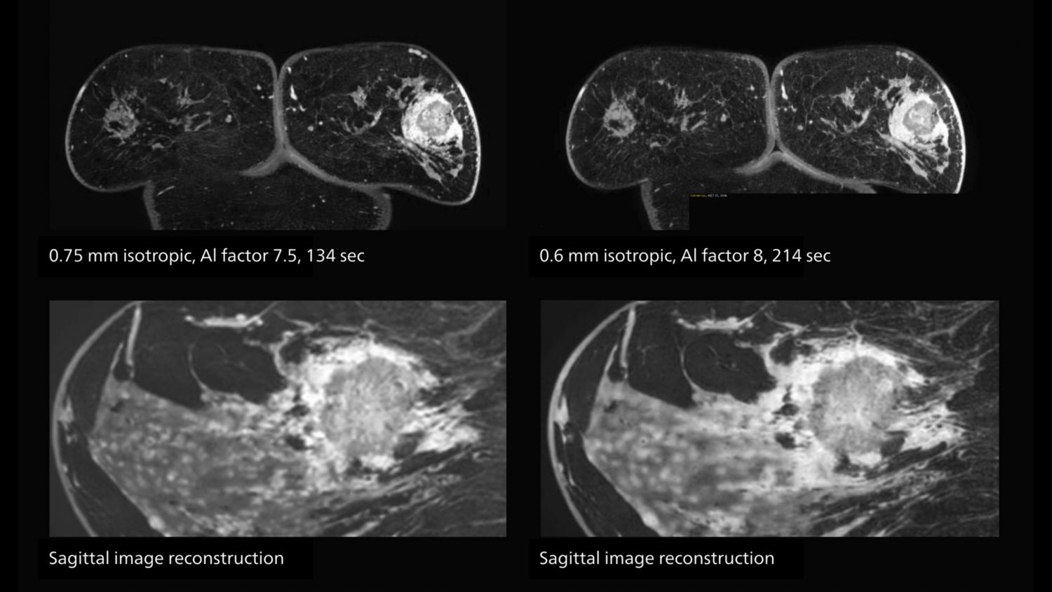 AI-enabled 3D MRI of breast cancer