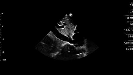 Longitudinal inferior vena cava shown using S4-1 transducer.